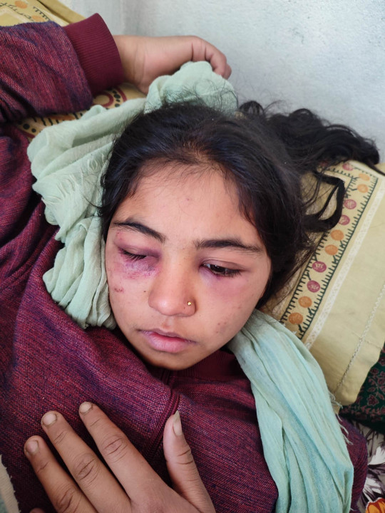 सौतेनी आमाको कुटपिटबाट बालिका गम्भीर घाइते